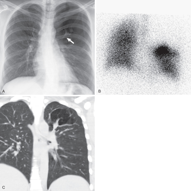 Fig. 7.4, Bronchial atresia. (A) Posteroanterior chest radiograph shows a hyperlucent left upper lobe with subtle rightward mediastinal shift. A left perihilar branching, tubular-shaped opacity (arrow) represents mucoid impaction distal to the atresia. (B) Anterior projection ventilation scintigraphic image from a technetium-99m diethylene triamine pentaacetic acid examination in the same patient shows lack of radiotracer distribution to the hyperlucent left upper lobe. (C) Coronal CT in a different patient shows a dilated mucus-filled bronchus with distal hyperlucency resulting from air trapping in the apicoposterior segment.