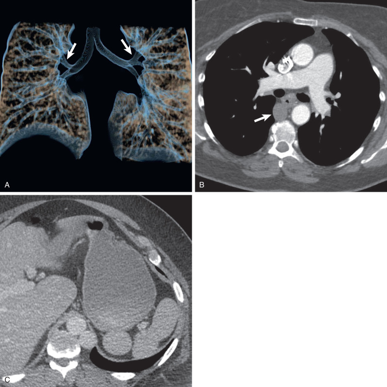 Fig. 7.5, Heterotaxy syndrome. Three-dimensional reconstruction of multidetector computed tomography tracheobronchial tree (A) shows symmetric long main bronchi with late takeoff of the upper lobe bronchi (arrows) bilaterally, indicating bilateral left-sidedness or left isomerism. Axial computed tomography angiography (CTA) (B) shows an enlarged azygos vein (arrow) resulting from interrupted inferior vena cava and bilateral pulmonary arteries arching over the main bronchi, indicating bilateral hyparterial bronchi. The latter relationship is often best appreciated on coronal reconstructions. Axial CTA (C) shows multiple spleens, consistent with left isomerism and polysplenia.