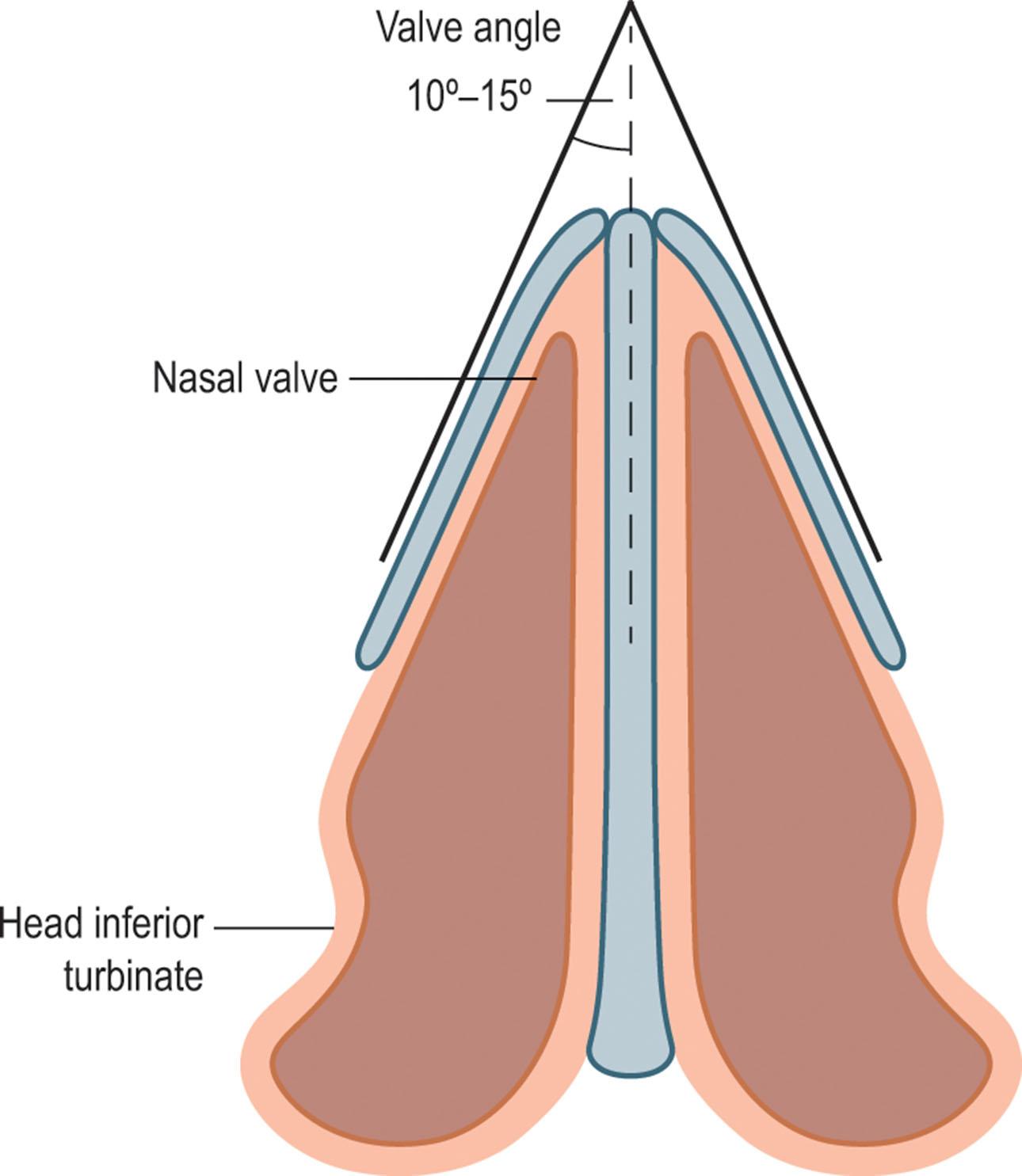 Figure 21.3, The internal nasal valve is defined by the angle between the junction of the nasal septum and the caudal margin of the upper lateral cartilage and is typically 10–15°.