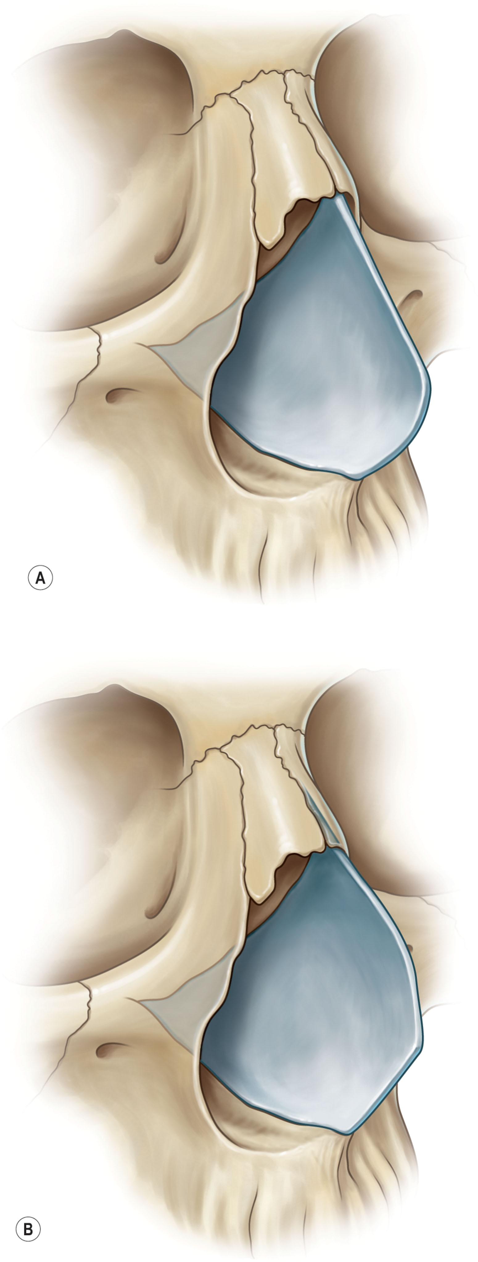 Figure 21.6, (A) C-shaped septal deviation, anteroposterior. (B) C-shaped septal deviation, cephalocaudal.