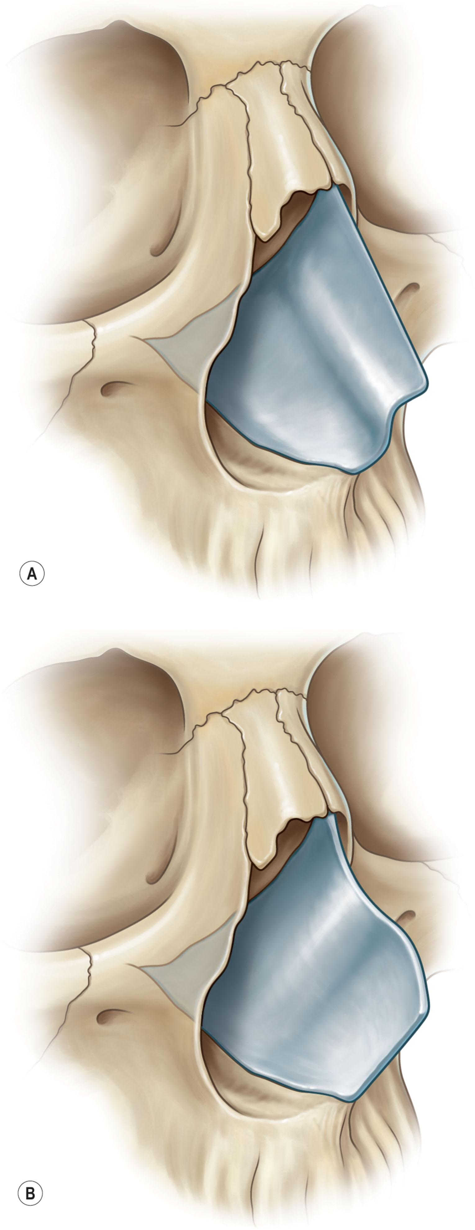 Figure 21.7, Localized S-shaped septal deviation and septal spur. (A) S-shaped curve cephalocaudal. (B) S-shaped curve anteroposterior.