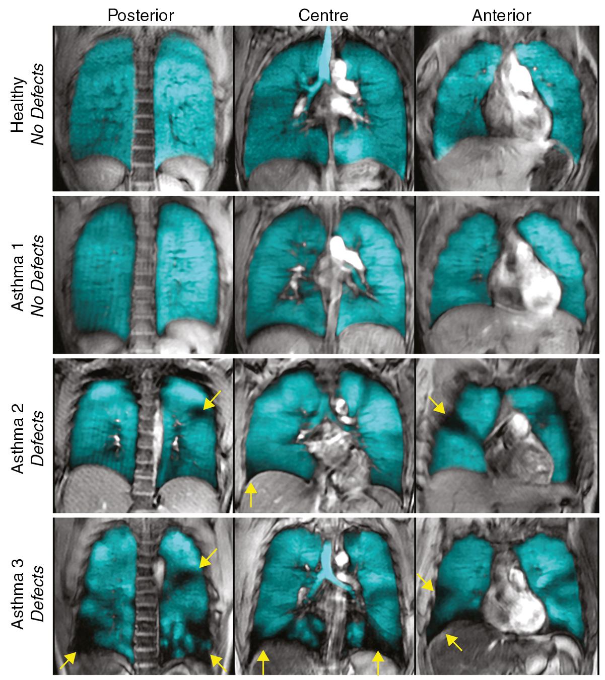 • Fig. 28.1, Hyperpolarized 3 He magnetic resonance imaging (MRI) scans of the lung following inhaled methacholine challenge. Ventilation distribution ( blue ) is superimposed on a standard MRI of the thorax, showing three coronal slices for each subject. The arrows show the ventilation defects in two of the subjects with asthma, which are not present in a different patient with asthma or the healthy control subject.