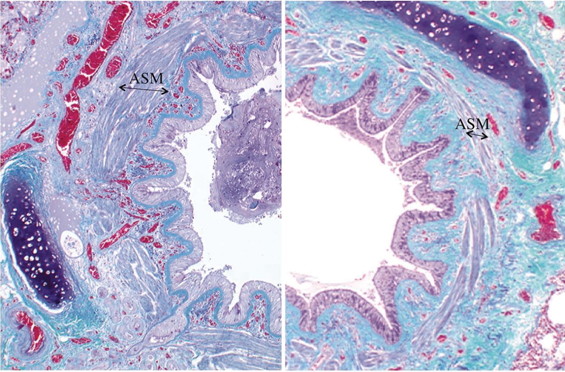 • Fig. 28.3, Histological section of a bronchiole from a patient with chronic asthma (left) and a healthy patient (right). Note the thickened layer of airway smooth muscle (ASM), the irregular mucosal folding and the debris in the airway.