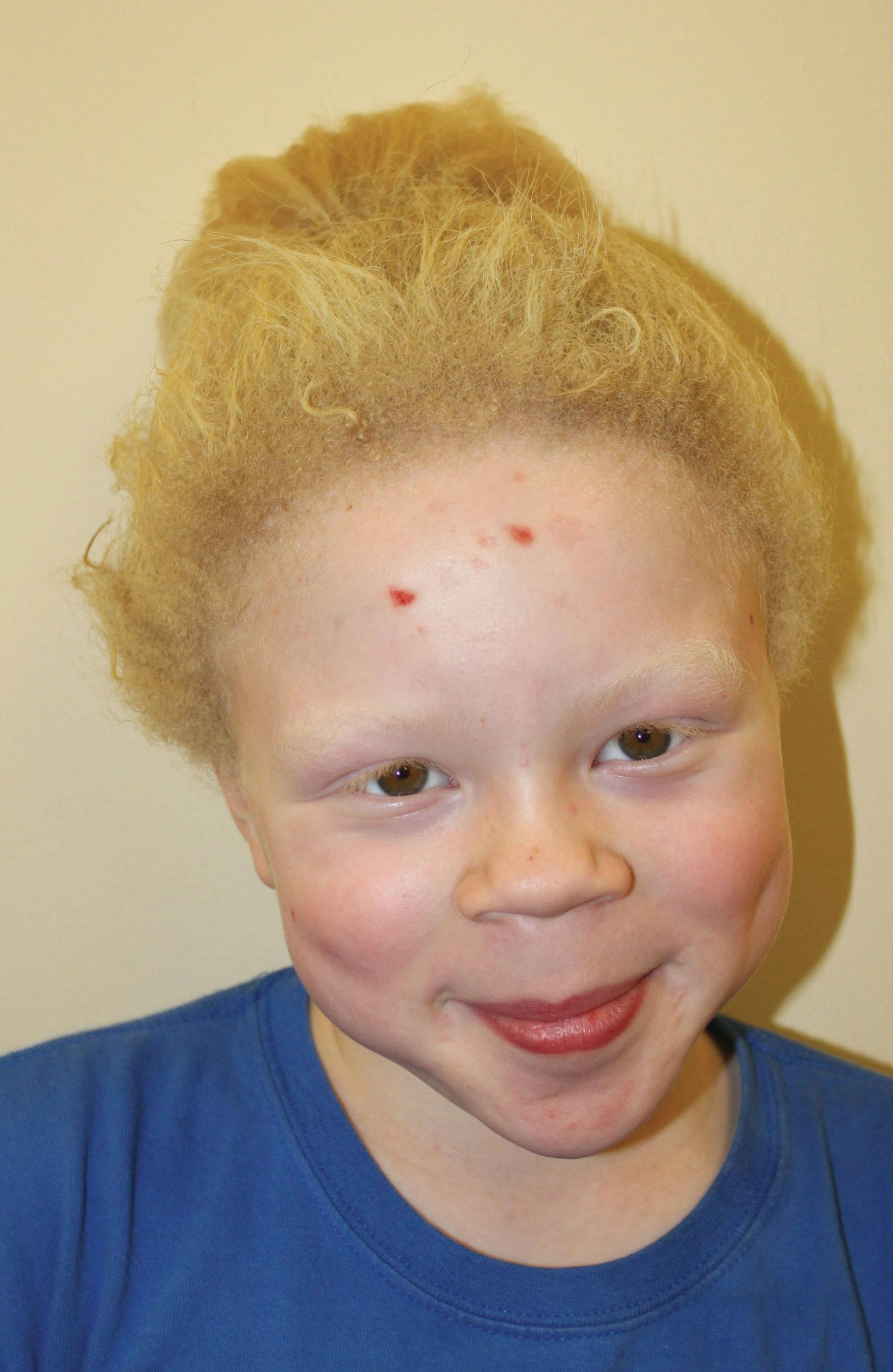 Fig. 40.3, This girl with African American heritage has mutations in the OCA2 gene that causes OCA2.