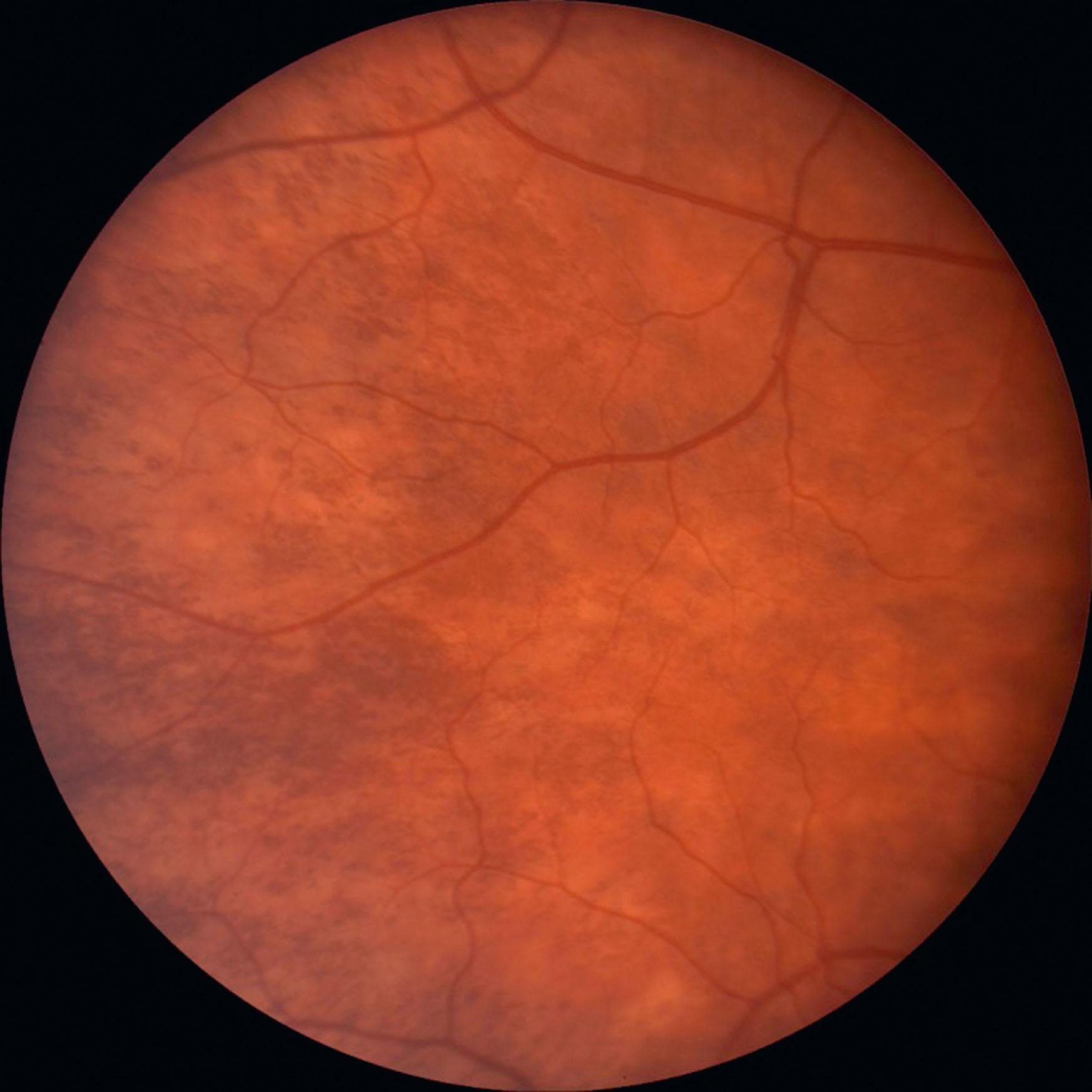 Fig. 40.4, Examination of the fundus of the obligate carrier for OA1 typically shows pigmentary mosaicism, with some areas having normal melanin pigment and other areas having no melanin pigment, as a manifestation of Lyonization.