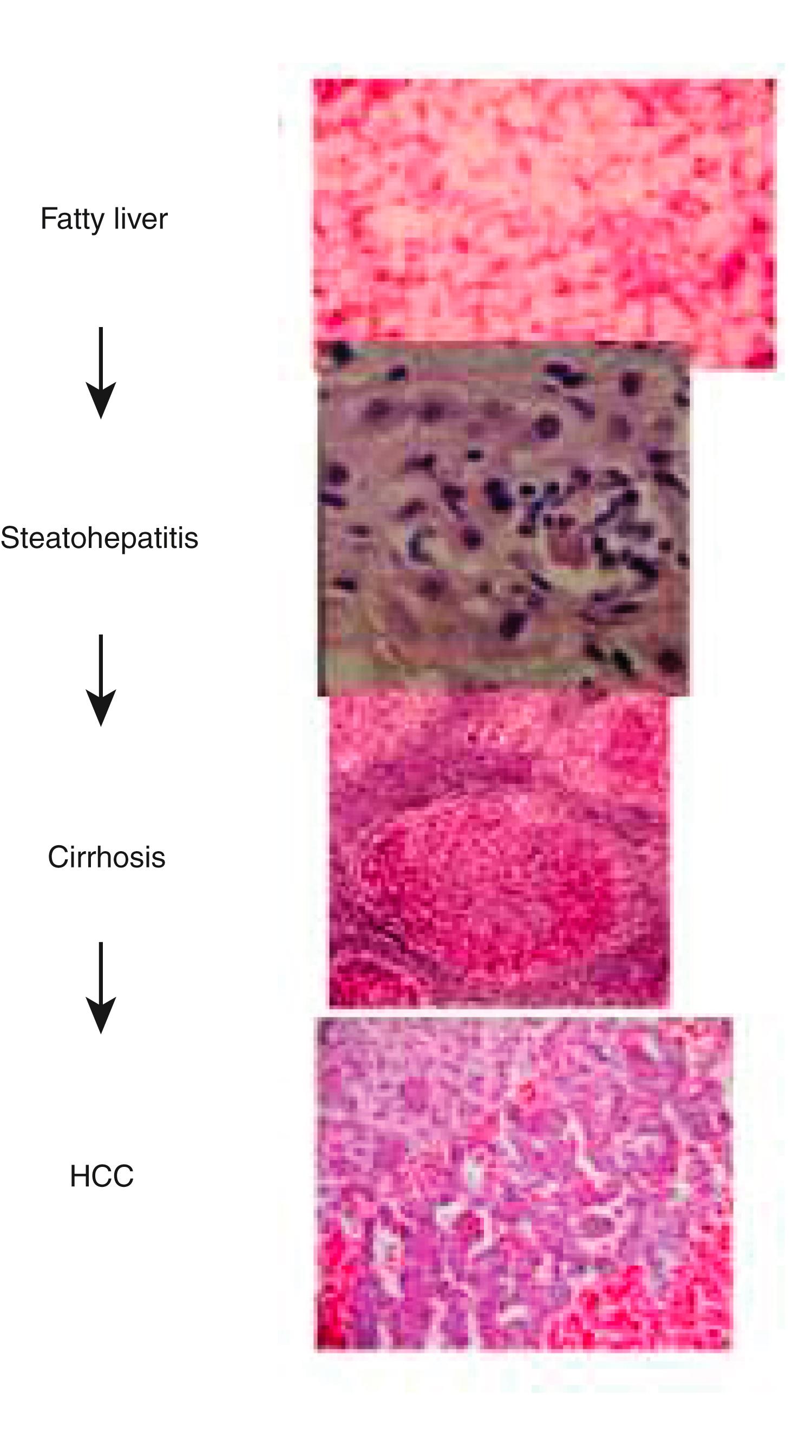 Fig. 86.2, Histologic spectrum of alcohol-associated liver disease.