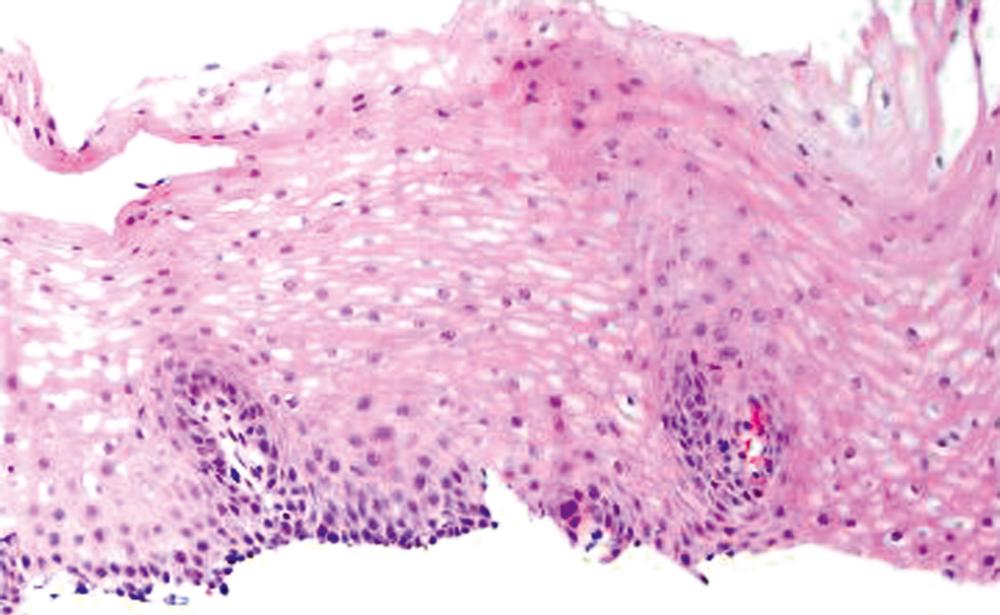 FIGURE 13.2, Normal esophageal squamous mucosa has a basal layer one to two cells thick and papillae restricted to the lower half.
