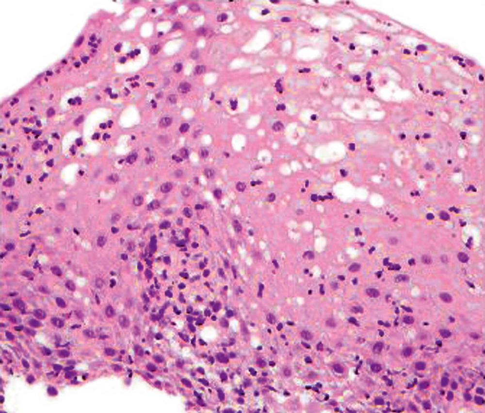 FIGURE 13.4, A neutrophil-predominant inflammatory infiltrate is often associated with infections but may be seen in association with gastroesophageal reflux disease, drugs, or corrosive mucosal injury.