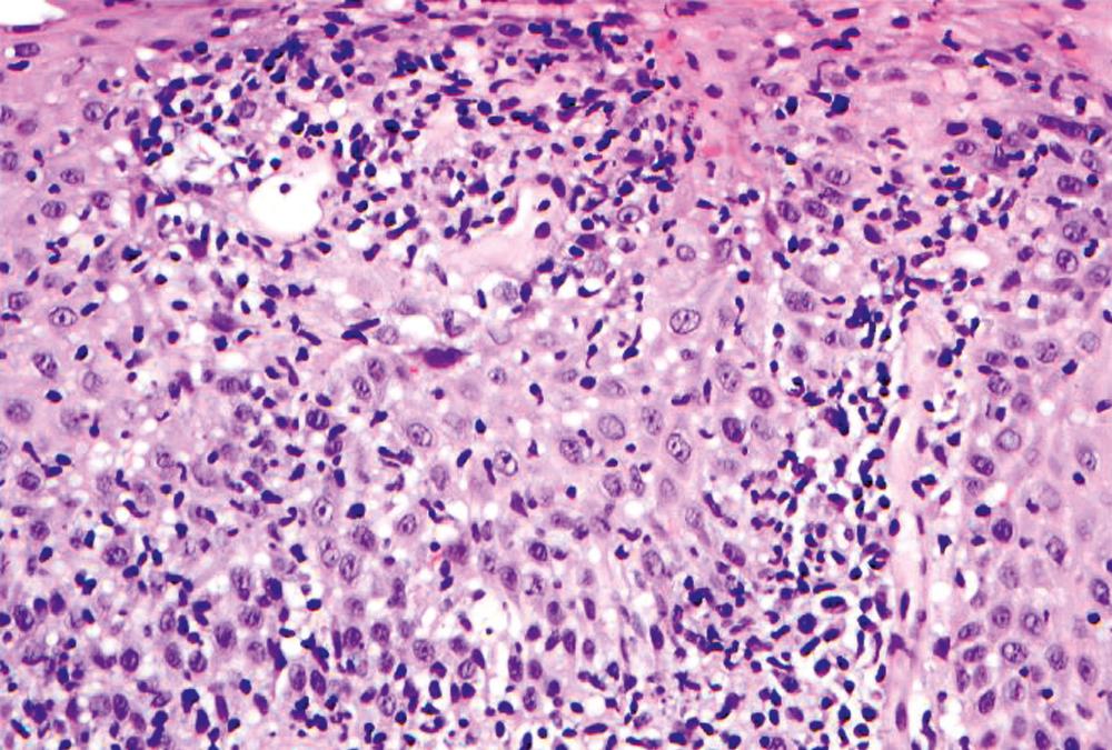 FIGURE 13.5, Lymphocytic esophagitis is a poorly defined entity with many etiological associations. It is characterized by increased intraepithelial lymphocytosis with peripapillary accentuation and spongiosis.