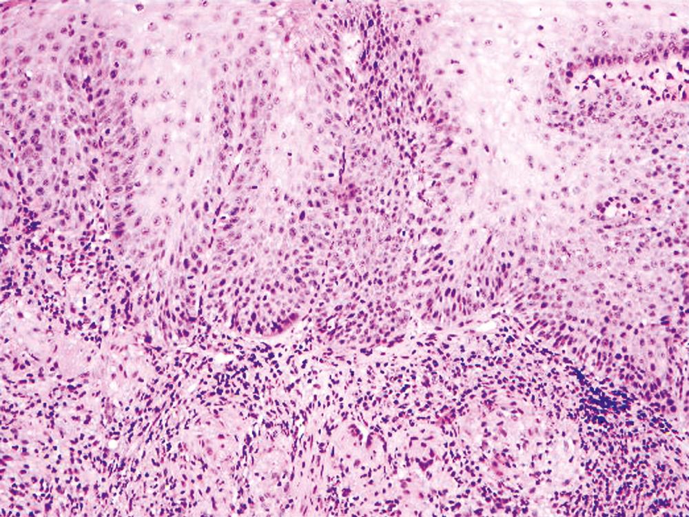 FIGURE 13.6, Granulomatous esophagitis is most commonly a manifestation of Crohn’s disease or sarcoidosis.