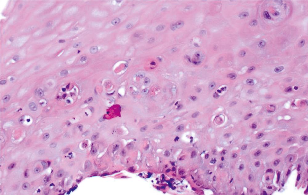 FIGURE 13.7, Graft-versus-host disease is characterized by minimal inflammation and single-cell epithelial necrosis. Similar features can be seen in drug-induced mucosal injury.