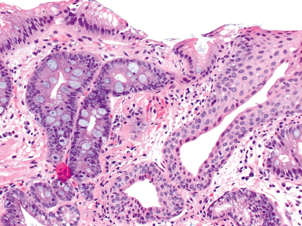 FIGURE 13.8, Intestinal metaplasia in a biopsy obtained from the gastroesophageal junction (GEJ). The presence of esophageal ducts or glands adjacent to foci of intestinal metaplasia indicates that the sample was obtained from the distal esophagus. However, a definitive diagnosis of Barrett’s esophagus requires that intestinal metaplasia is documented in a distal esophageal biopsy that is obtained at a distance ≥ 1 cm above the GEJ.