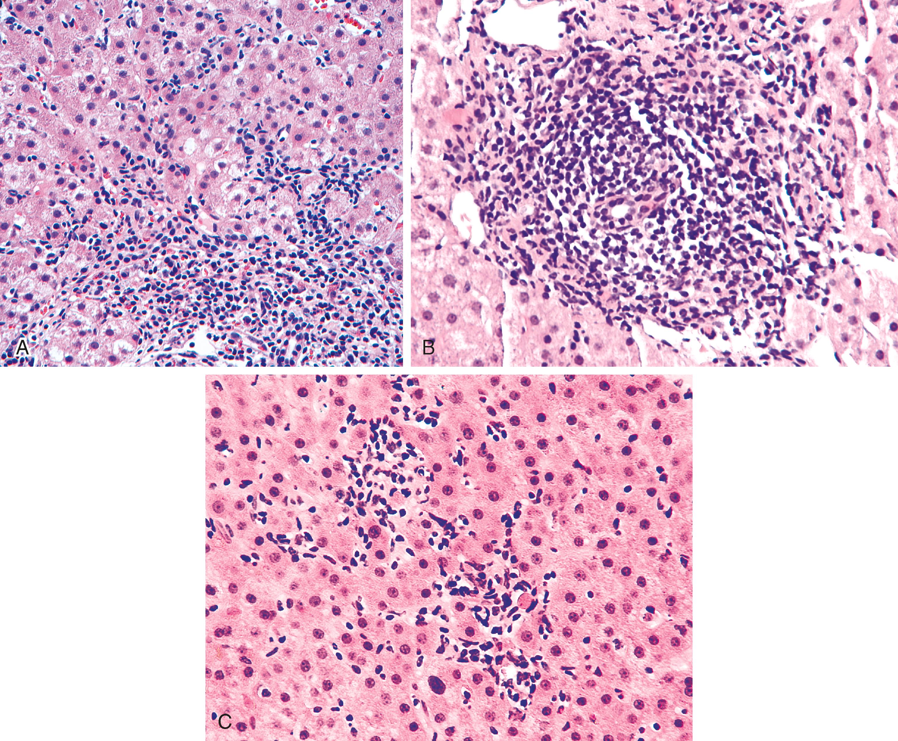 FIGURE 43.3, A, Chronic hepatitis B showing interphase activity. The inflammation extends from the portal tract beyond the limiting plate and into the adjacent parenchyma. B, Portal inflammation in chronic hepatitis B consists predominantly of lymphocytes surrounding an entrapped bile duct, which is mostly intact. C, A variable amount of lobular inflammation associated with hepatocyte damage is also usually present in chronic hepatitis.