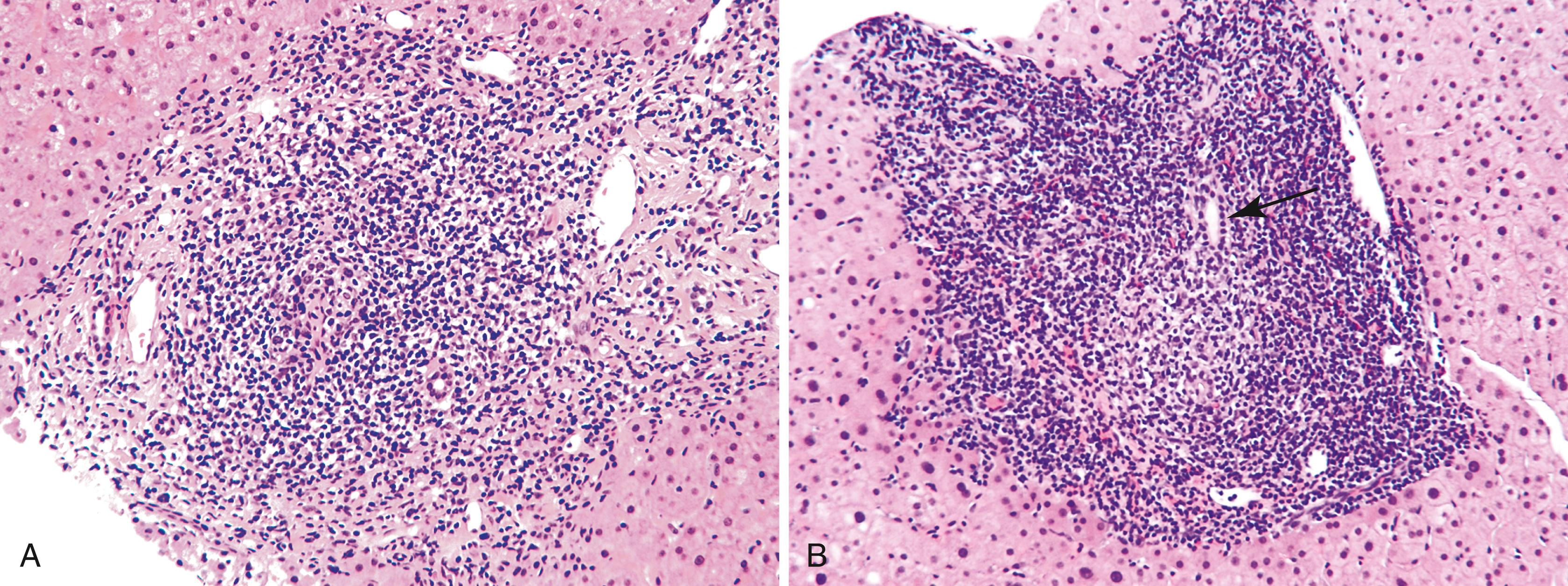 FIGURE 43.4, Lymphoid follicles are often associated with chronic hepatitis C (A) but may also be seen in other forms of chronic viral hepatitis, autoimmune hepatitis, and primary biliary cirrhosis ( B ; arrow marks bile duct under immune attack).