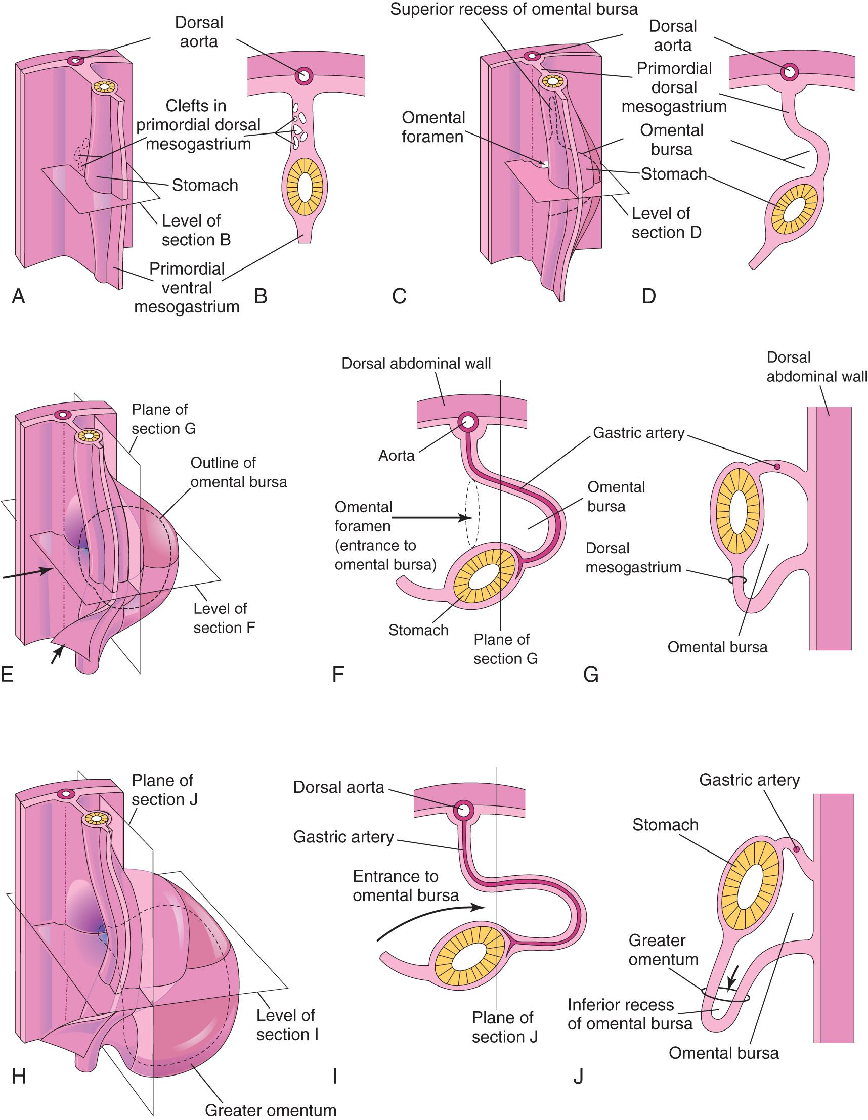 Fig. 11.3, Development of stomach and mesenteries and formation of omental bursa. A , Embryo of 5 weeks. B , Transverse section showing clefts in the dorsal mesogastrium. C , Later stage after coalescence of the clefts to form the omental bursa. D , Transverse section showing the initial appearance of the omental bursa. E , The dorsal mesentery has elongated, and the omental bursa has enlarged. F and G , Transverse and sagittal sections, respectively, showing elongation of the dorsal mesogastrium and expansion of the omental bursa. H , Embryo of 6 weeks showing the greater omentum and expansion of the omental bursa. I and J , Transverse and sagittal sections, respectively, showing the inferior recess of the omental bursa and the omental foramen. The arrows in E , F , and I indicate the site of the omental foramen. In J , the arrow indicates the inferior recess of the omental bursa.