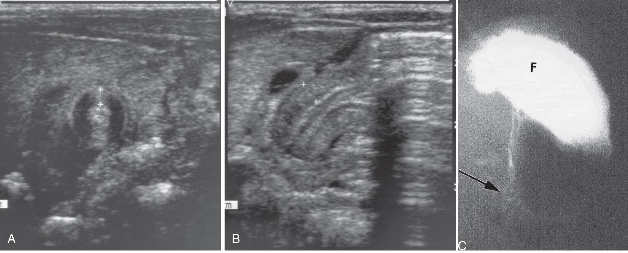 Fig. 11.4, A , Transverse abdominal sonogram demonstrating a pyloric muscle wall thickness of greater than 4 mm (distance between crosses) . B , Horizontal image demonstrating a pyloric channel length greater than 14 mm in an infant with hypertrophic pyloric stenosis. C , Contrast radiograph of the stomach in a 1-month-old male infant with pyloric stenosis. Note the narrowed pyloric end (arrow) and the distended fundus (F) of the stomach, filled with contrast material.