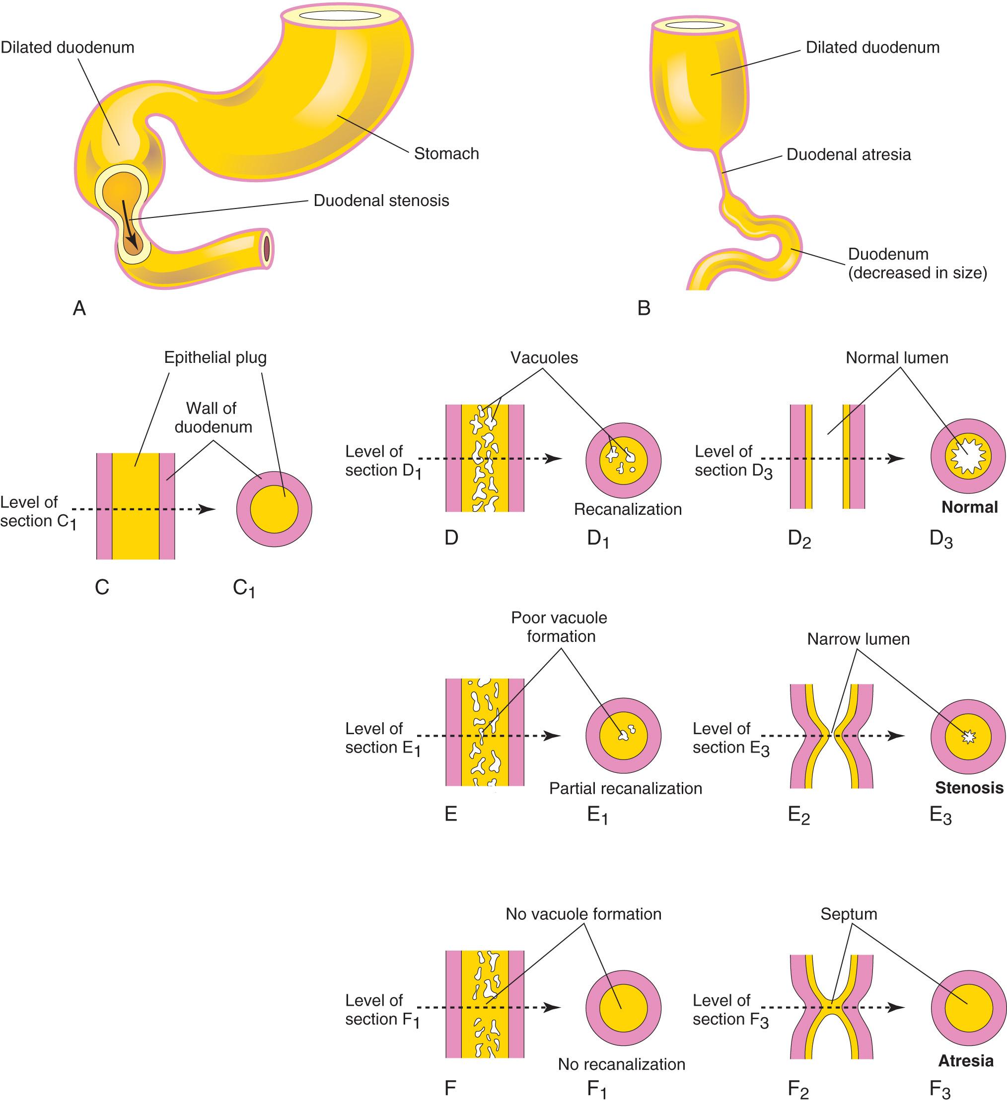 Fig. 11.6, Drawings showing the embryologic basis of common types of congenital intestinal obstruction. A , Duodenal stenosis. B , Duodenal atresia. C to F , Diagrammatic longitudinal and transverse sections of the duodenum showing (1) normal recanalization ( D to D 3 ), (2) stenosis ( E to E 3 ), and atresia ( F to F 3 ).
