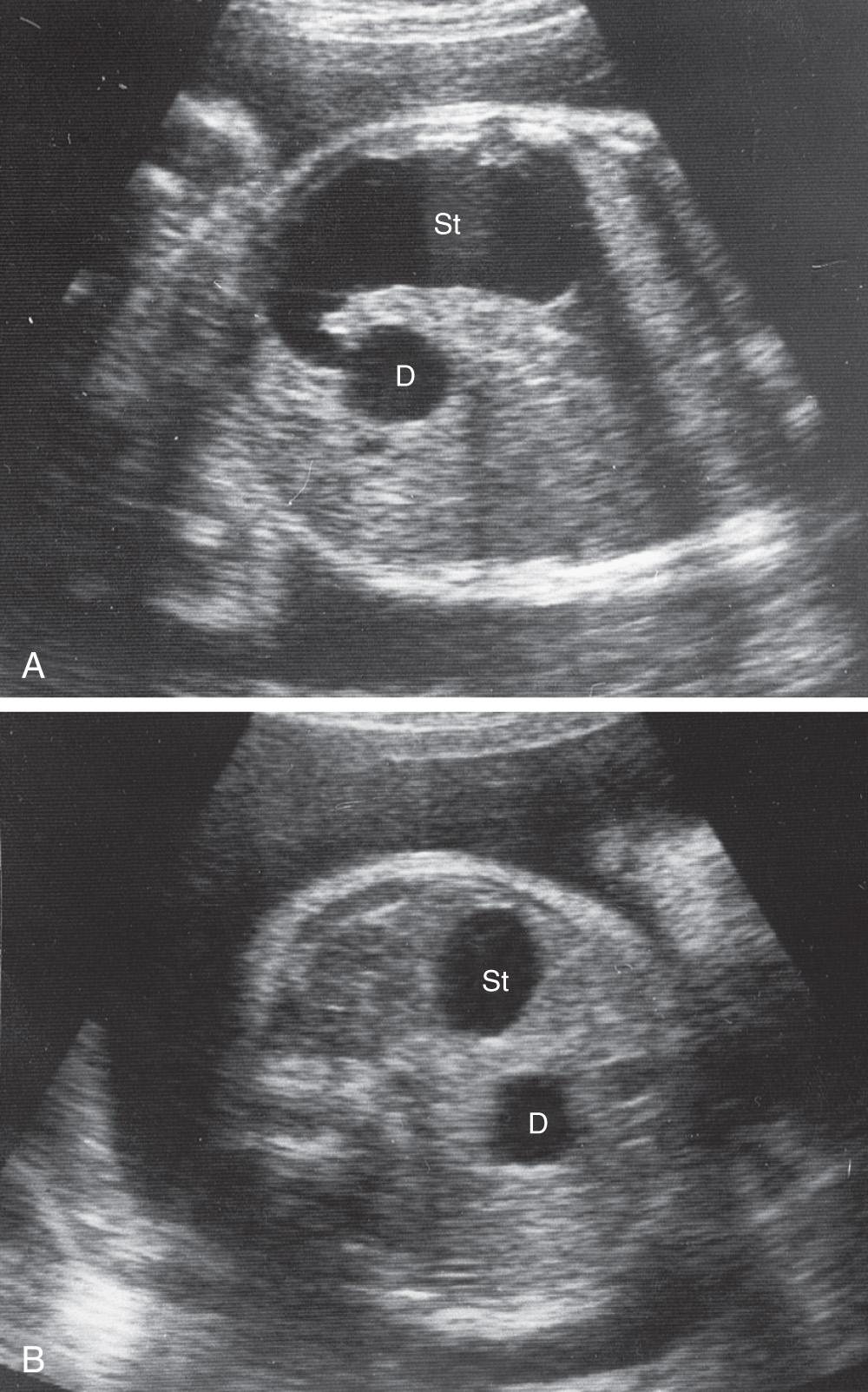 Fig. 11.7, Ultrasound scans of a fetus of 33 weeks showing duodenal atresia. A , An oblique scan showing the dilated, fluid-filled stomach (St) entering the proximal duodenum (D), which is also enlarged because of atresia (blockage) distal to it. B , Transverse scan illustrating the characteristic “double-bubble” appearance of the stomach and duodenum when there is duodenal atresia.