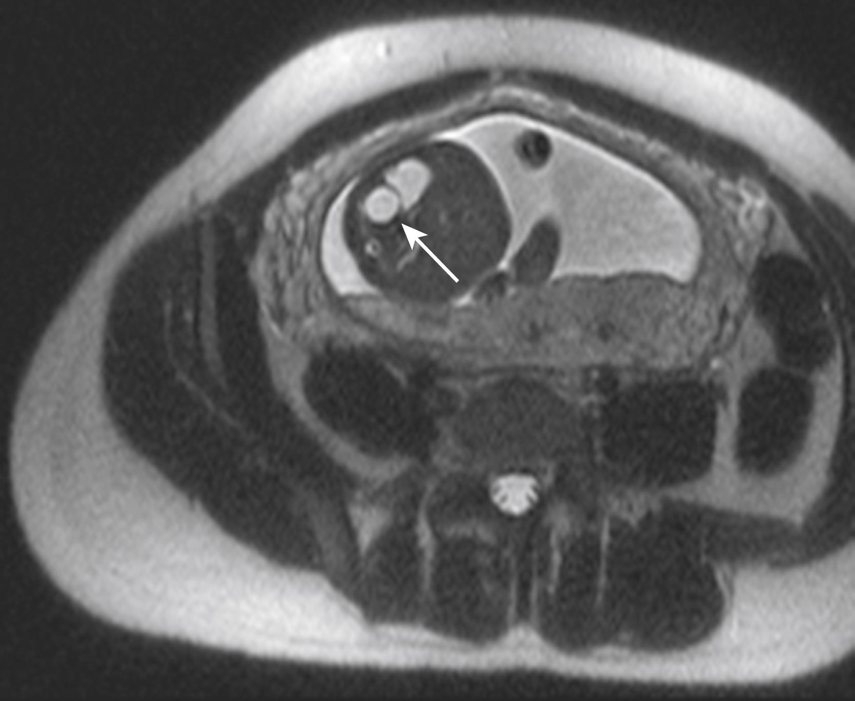 Fig. 39.1, This T2–weighted transverse MRI image was obtained from a 22-weeks gestational age fetus. The white arrow identifies a hyperintense cystic-like structure that is a gastric duplication protruding through the native gastric wall.