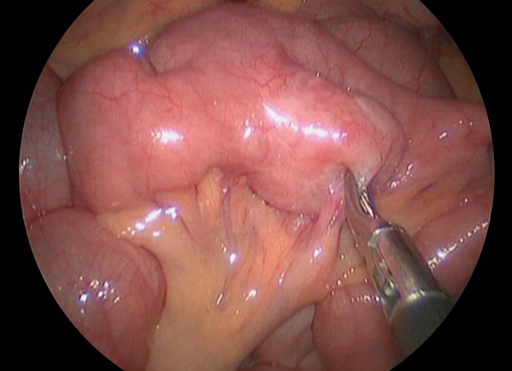 Fig. 39.2, Most alimentary tract duplications are cystic. In this laparoscopic photograph, note the cystic duplication being grasped by the Maryland instrument. Its blood supply can be seen just below the tip of the instrument. As opposed to a Meckel diverticulum, which is found on the antimesenteric side of the bowel, duplications are located on the mesenteric side.