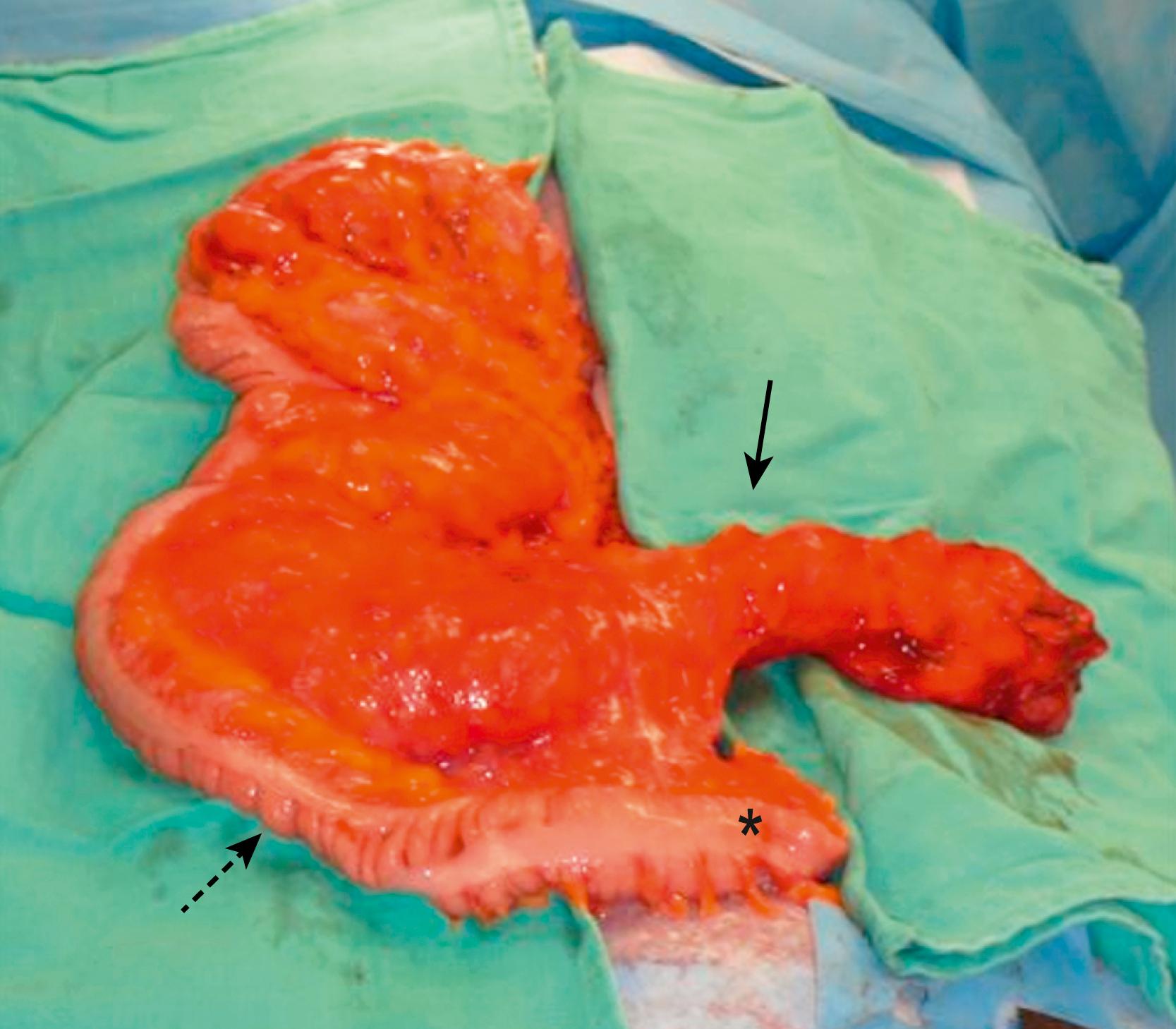 Fig. 39.3, This operative photograph shows a child with a tubular colonic duplication (solid arrow). The duplications are always on the mesenteric side of the native colon. In this photograph, the cecum is marked by the asterisk and the native colon is identified with the dotted arrow.