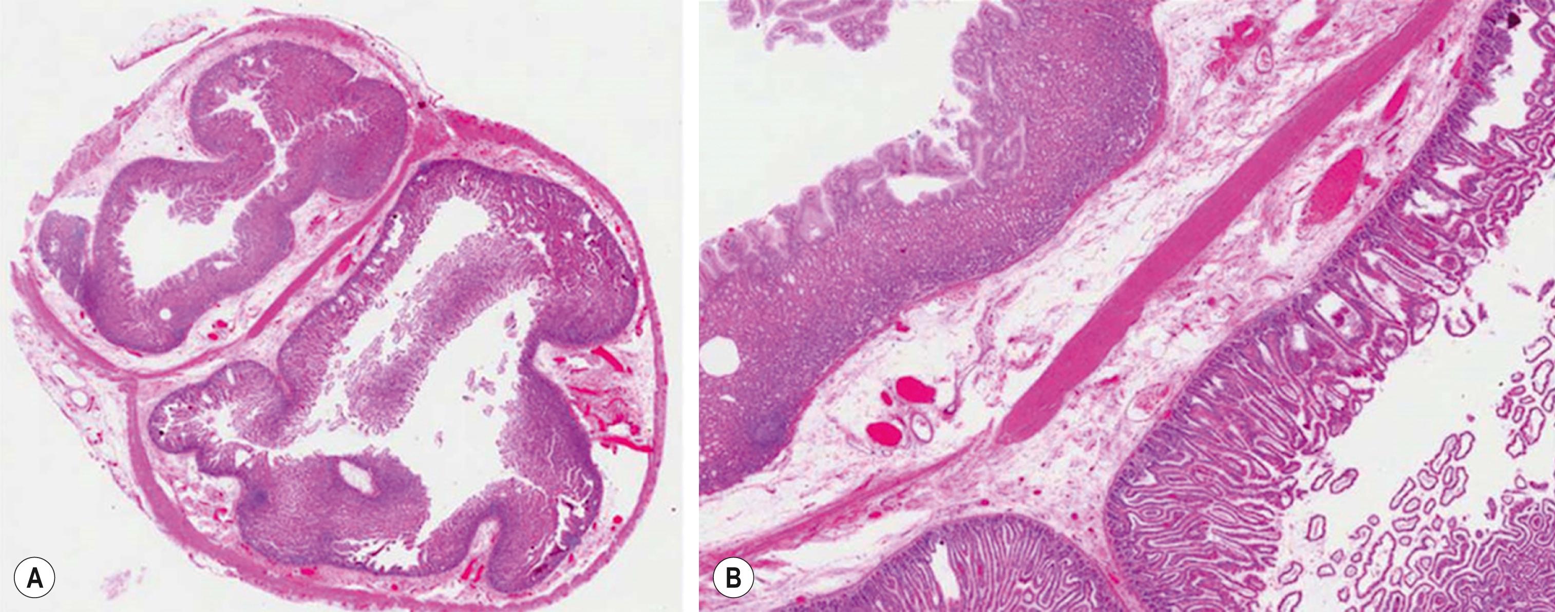 Fig. 39.4, These two histologic images were taken from a tubular jejunal duplication. On the left (A) the low-power image shows two lumens that are separated by a singular muscular wall. On the right (B), the medium-power image shows the gastric mucosa from the duplication (left) and the small intestinal mucosa with villi from the native jejunum (right).