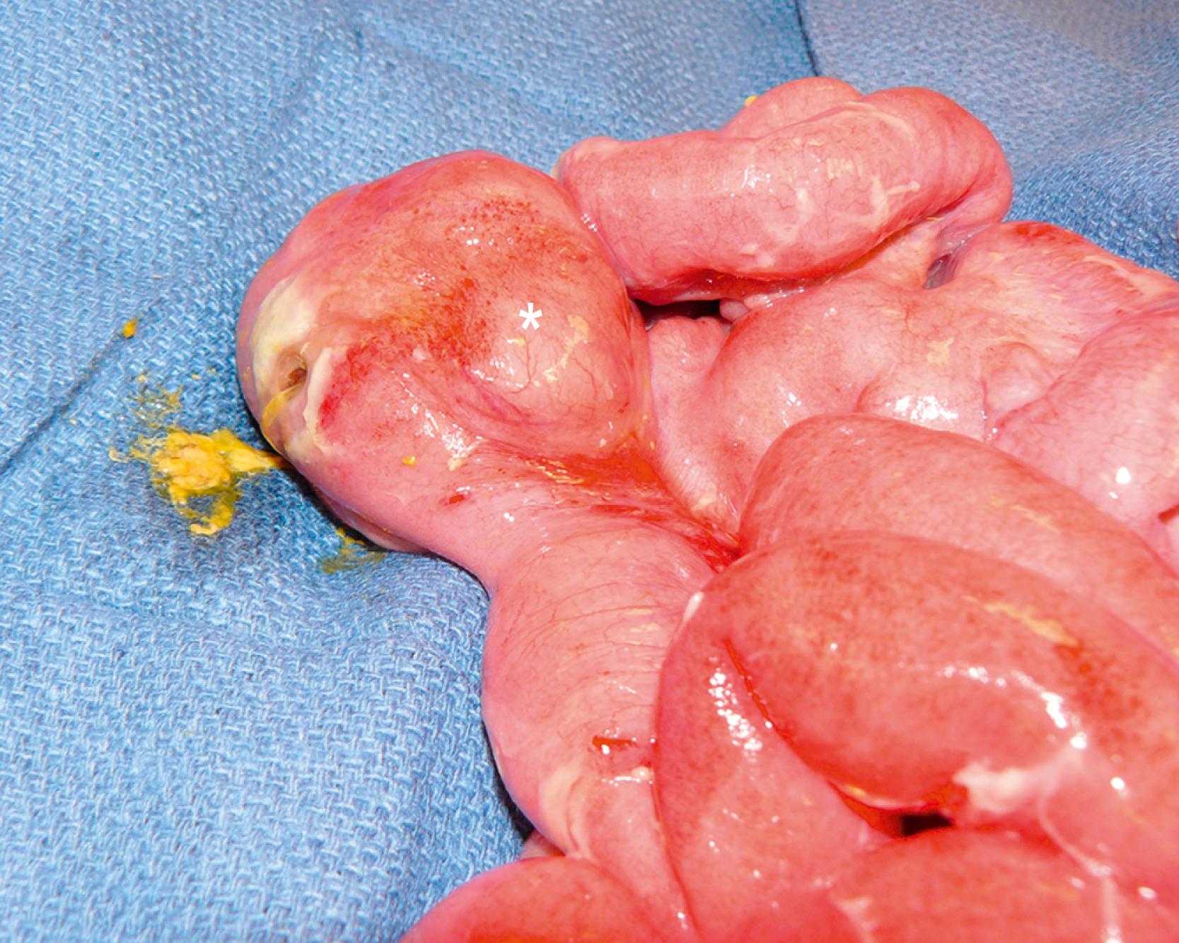 Fig. 39.5, This infant presented with abdominal distention and free air. Laparotomy was performed, and this perforation on the antimesenteric side of the distal small bowel was seen. The perforation occurred due to the duplication cyst located on the mesenteric border (asterisk). This patient underwent segmental small bowel resection and recovered uneventfully.