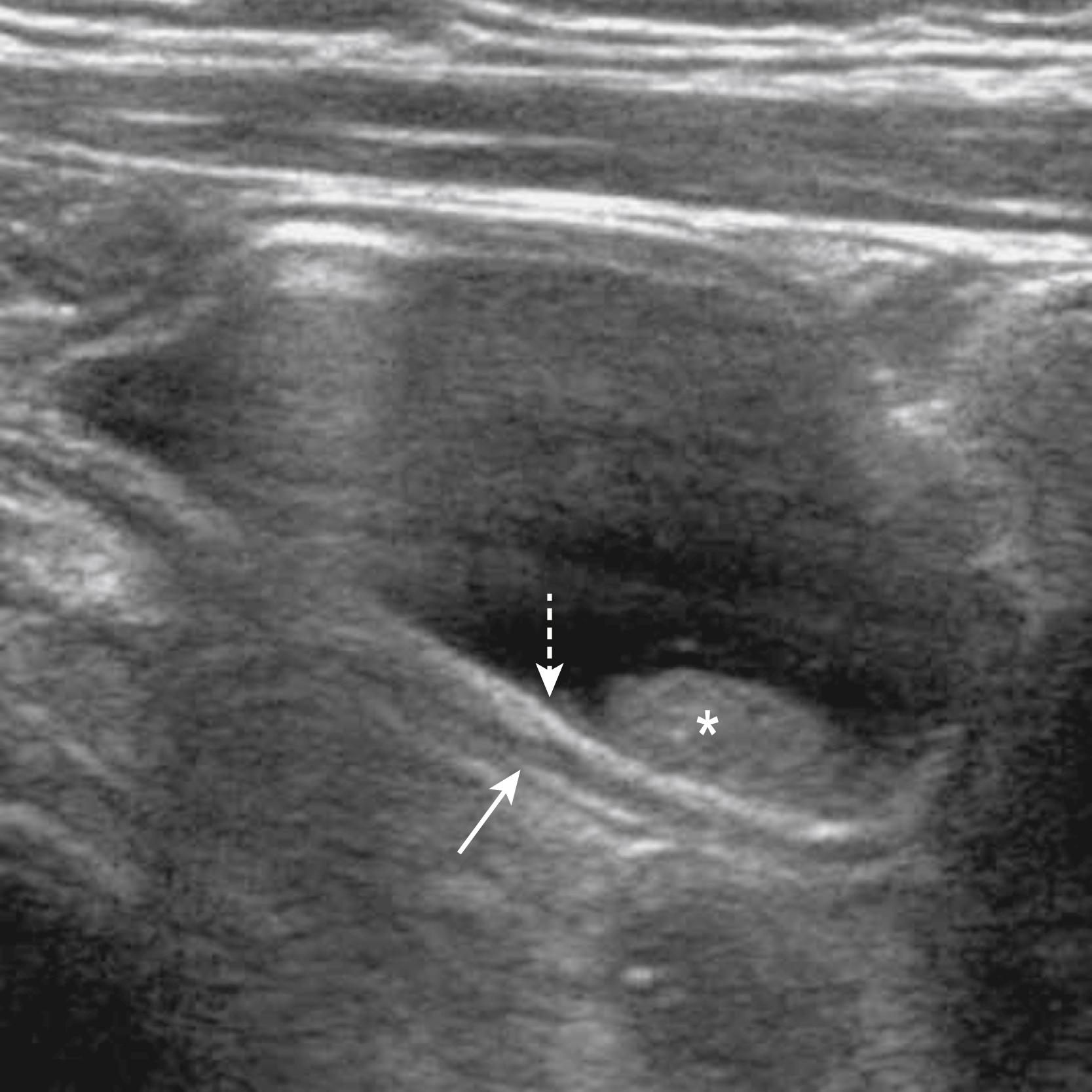 Fig. 39.6, Ultrasonography is a frequent imaging modality for diagnosing abdominal duplications. The typical sonographic appearance of a duplication demonstrates a cystic lesion with an inner hyperechoic rim of mucosa and submucosa (dotted arrow) and an outer rim of hyperechoic serosa (solid arrow) with a hypoechoic muscular layer between them. In this image, inspissated mucous (asterisk) is also seen.