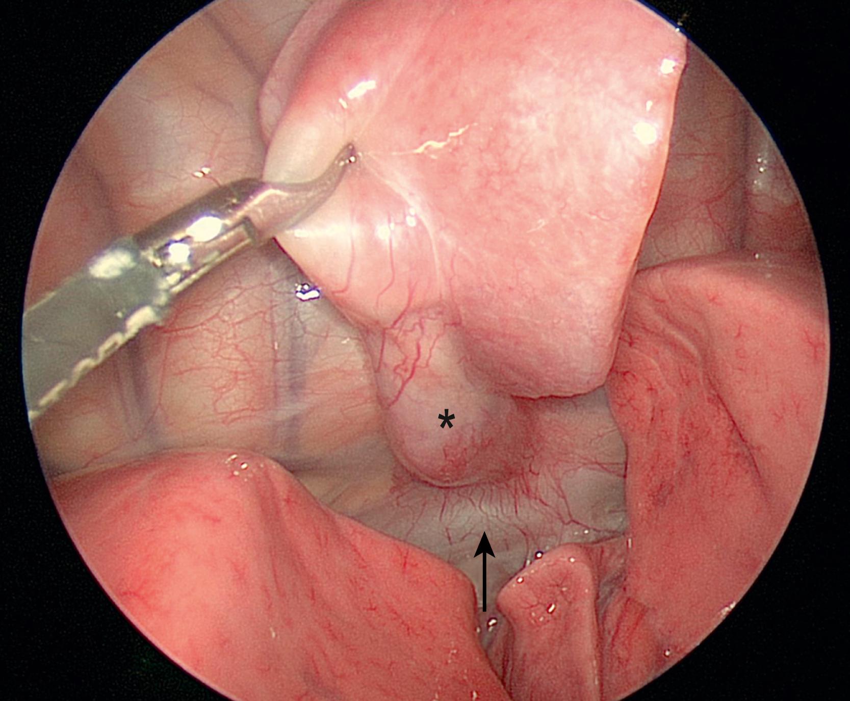 Fig. 39.7, This thoracoscopic view shows an esophageal duplication (asterisk) that is adjacent to the esophagus (arrow) and attached to a piece of primitive lung. Histologic analysis confirmed the mass as a duplication with primitive lung.