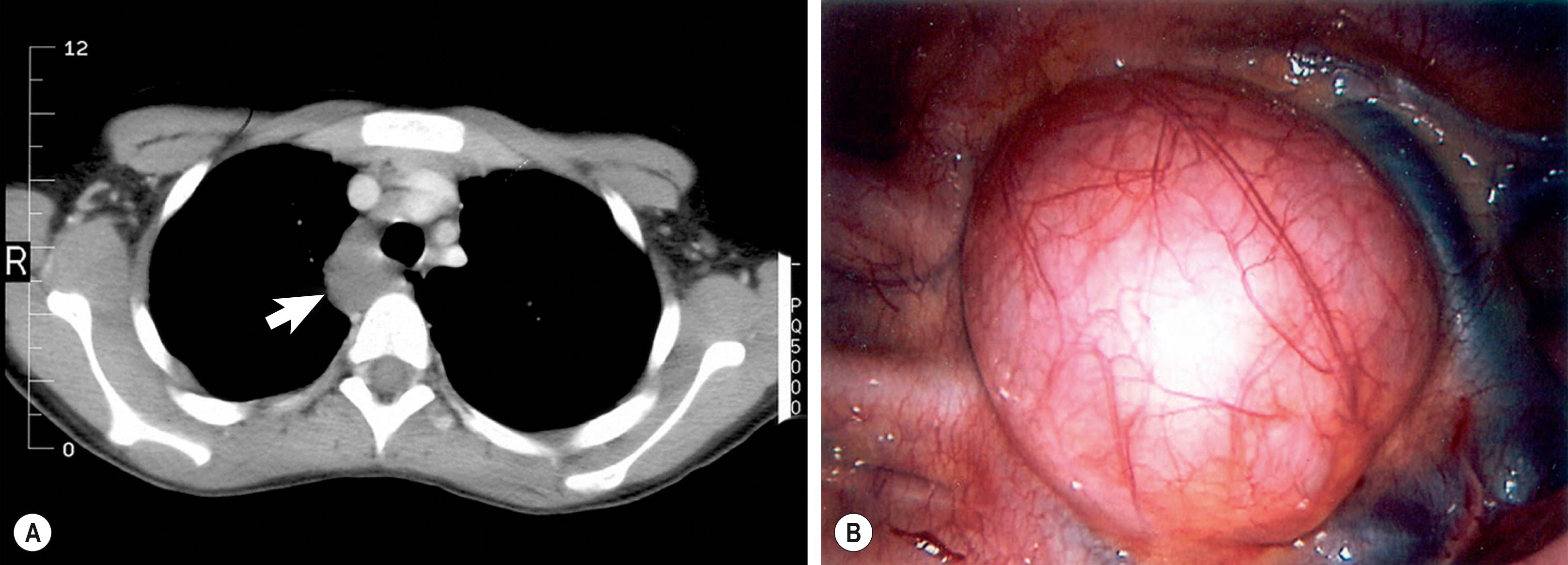 Fig. 39.8, This 16-year-old patient was found to have a posterior mediastinal mass on chest radiograph. CT scan (A) shows the duplication (arrow) to be adjacent to the trachea and the esophagus. On the right (B), the duplication is visualized at thoracoscopy and was excised without complications.