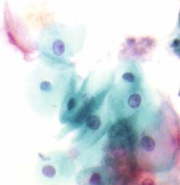 Figure 14-1, Normal esophageal cytology. Brushing of normal esophageal squamous mucosa demonstrating predominantly intermediate squamous cells (Papanicolaou, ×HP).
