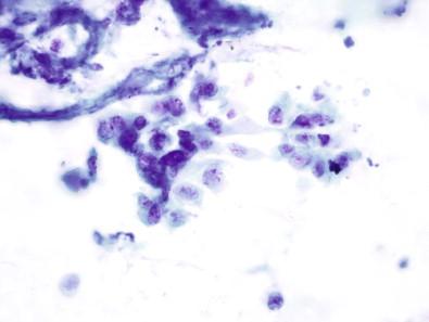 Figure 14-11, Esophageal adenocarcinoma. Brushings include loose clusters of cells and individually scattered cells with large pleomorphic nuclei with distorted membranes, nuclear overlap, hyperchromatic chromatin, and distinct nucleoli (Papanicolaou, ×HP).