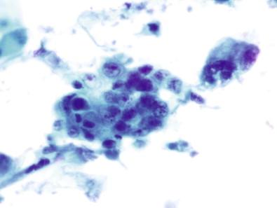 Figure 14-13, Poorly differentiated squamous cell carcinoma. Markedly hyperchromatic nuclei, very high N : C ratios, and cyanophilic cytoplasm are present. Keratinization is scant to absent (Papanicolaou, ×HP).