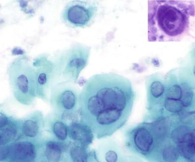 Figure 14-3, Herpes simplex esophagitis. The nuclei of the squamous cells are markedly enlarged, have thick nuclear membranes, and have homogeneous “ground-glass” chromatin. Molding is well developed (Papanicolaou, ×HP). In the inset, a Cowdry A inclusion is seen (Diff-Quik, ×HP).