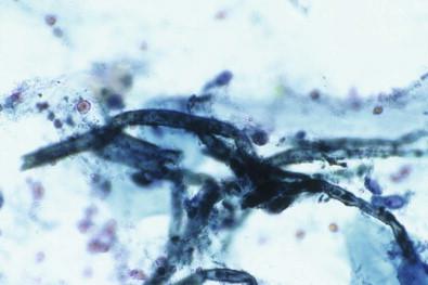 Figure 14-5, Aspergillus esophagitis. Compared with Candida , the hyphae of Aspergillus are thicker and cyanophilic, and show true septation and 45° acute angle branching (Papanicolaou, ×HP).