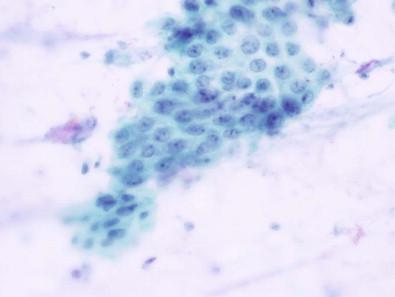 Figure 14-8, Repair changes. The metaplastic cells are arranged in a streaming architecture that resembles a school of fish swimming. The N : C ratios can be moderately elevated. The chromatin is pale with prominent nucleoli (Papanicolaou, ×HP).