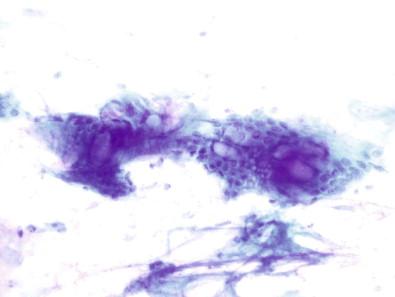 Figure 14-9, Intestinal metaplasia. Intestinal metaplasia is thought to be the step after columnar-like epithelium in the progress towards esophageal adenocarcinoma. Intestinal metaplasia is characterized by the presence of goblet cells in a background of columnar cell change. Goblet cells are barrel-shaped with an eccentric nucleus flattened against one end of the cell by a large amount of mucin that also causes the cell membranes to bulge (Papanicolaou, ×HP).