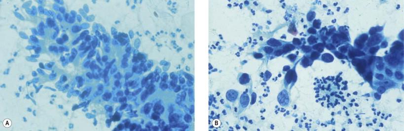Figure 14-10, Aggregates of dysplastic Barrett's epithelium. (A) These are frayed and irregular. The nuclei are enlarged, hyperchromatic, and crowded. Polarity is distorted. Note the absence of individually dispersed intact abnormal cells. Although mucin depletion and nuclear enlargement are seen, significant nuclear atypia is absent (Papanicolaou, ×MP). (B) A sheet of irregularly arranged abnormal nuclei with high N : C ratios, nuclear membrane irregularities, and hyperchromasia. Note that the group still maintains cohesion. These features of dysphasia may be difficult to distinguish from those of well-differentiated adenocarcinoma (Papanicolaou, ×HP).