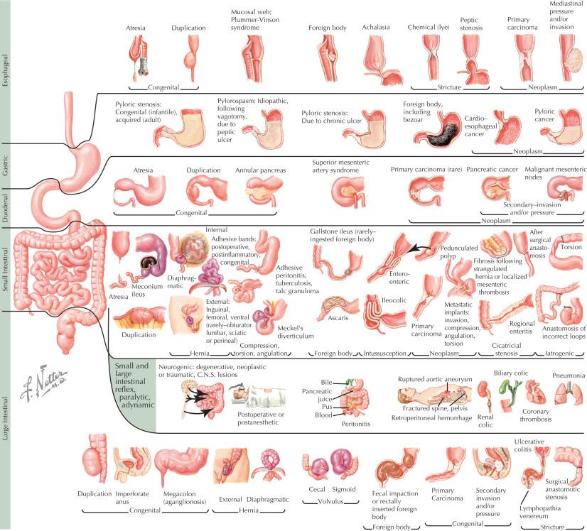 Fig. 47.1, Alimentary Tract Obstruction.
