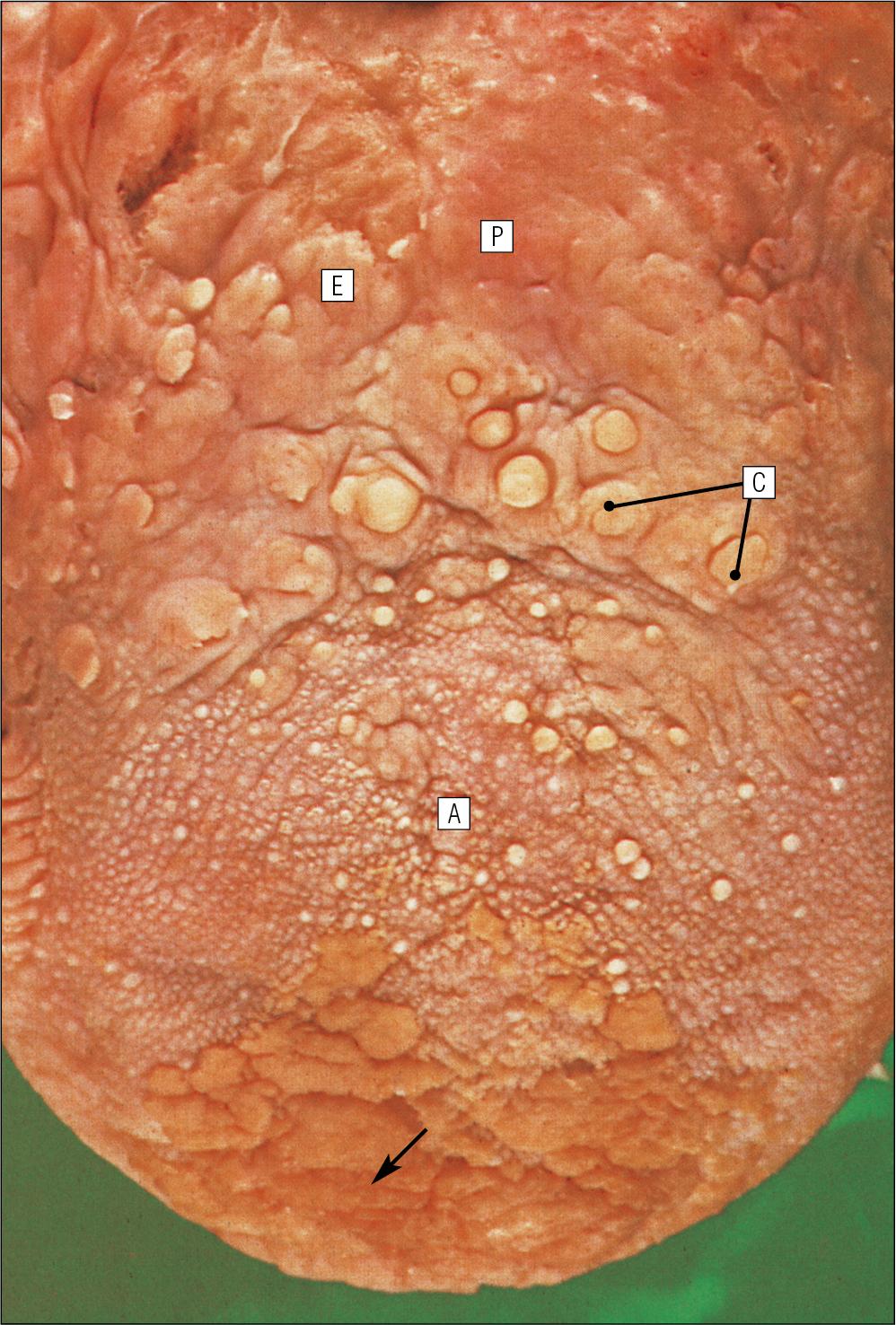 Fig. 11.2, Dorsal Surface of the Tongue.