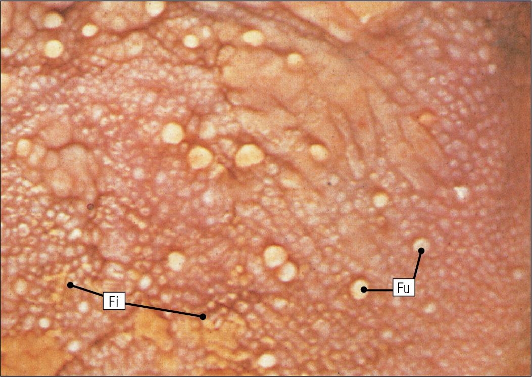 Fig. 11.5, Fungiform and Filiform Papillae.