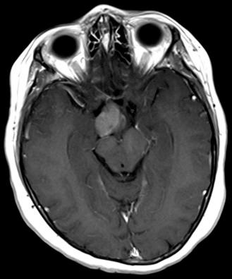 Figure 13.1, Optic nerve glioma in a patient with NF1 (axial T1 MRI with contrast).