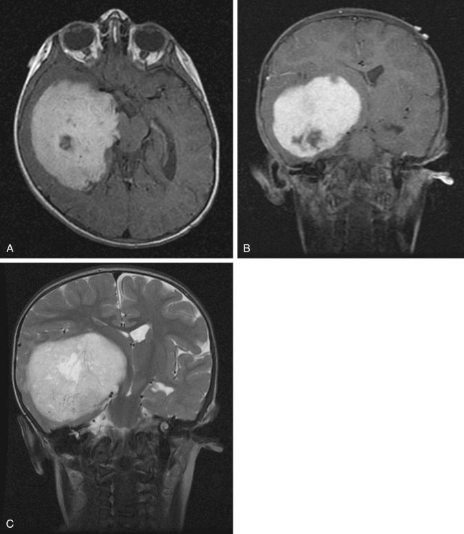 Figure 13.2, Pilomyxoid astrocytoma of the right hemisphere. (A) Axial T1 MRI with contrast. (B) Coronal T1 MRI with contrast. (C) Coronal T2 MRI.