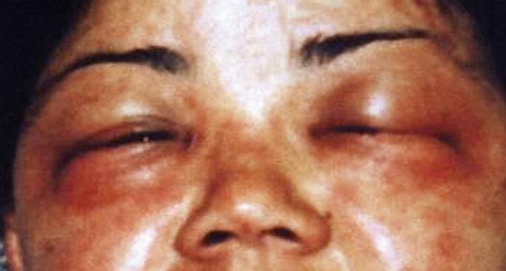 Fig. 162.1, Marked eyelid swelling may mimic the angioedema of anaphylaxis, but with ACD there is only localized pruritus and no associated systemic signs or symptoms. This case was caused by contact with the allergen in hair dye.