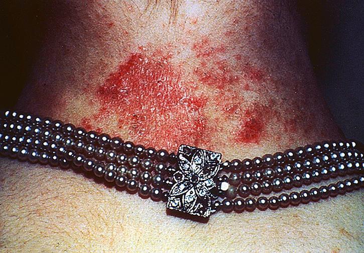 Fig. 162.2, The classic erythematous papulovesicular eruption of ACD on the back of this patient’s neck is caused by contact from nickel-plated jewelry.