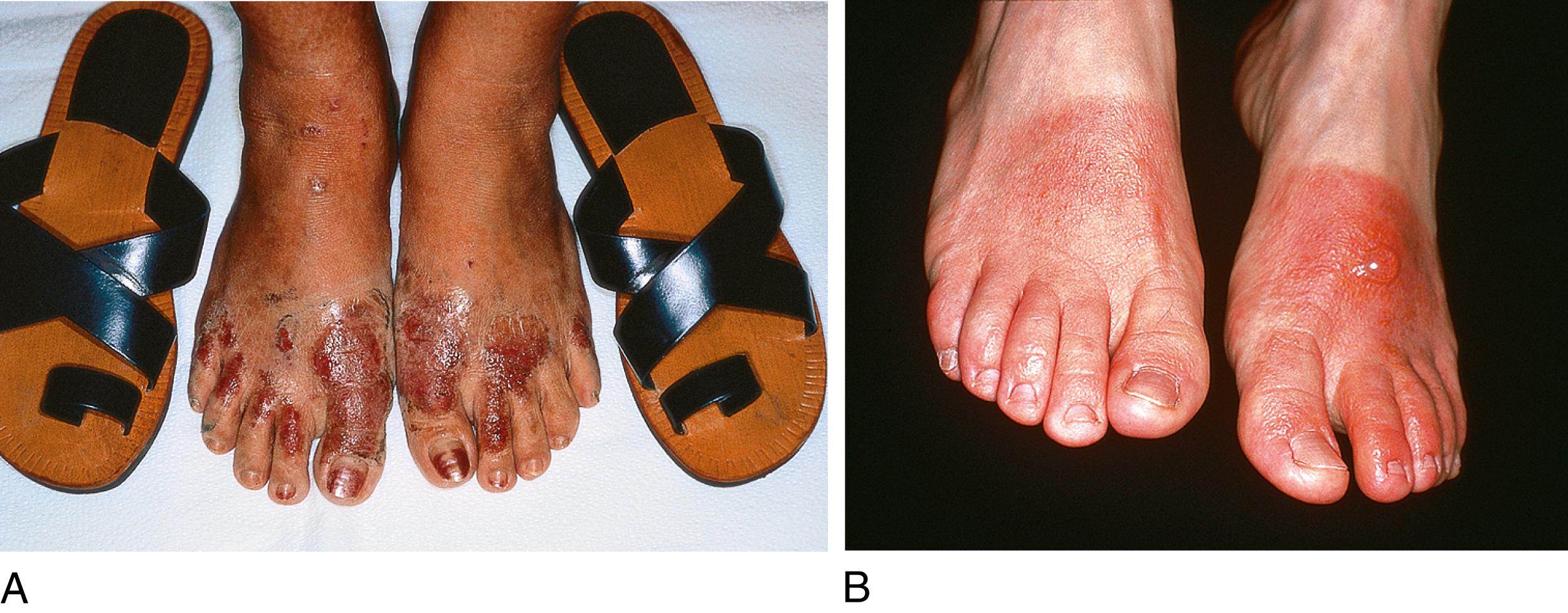 Fig. 162.3, (A, B) Allergic contact dermatitis to leather shoes. Note the correspondence to sites of exposure.