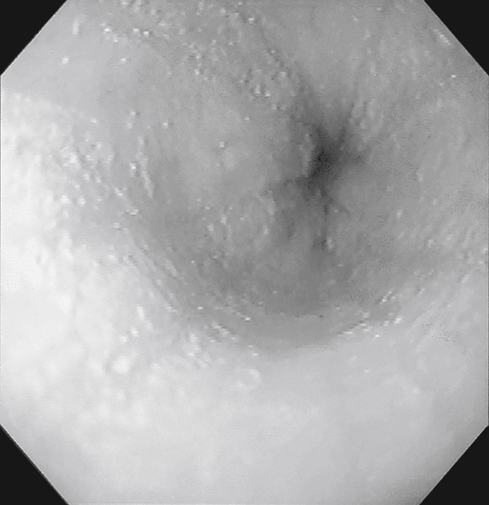 Fig. 37.2, White plaques seen in the midesophagus in a patient with eosinophilic esophagitis.