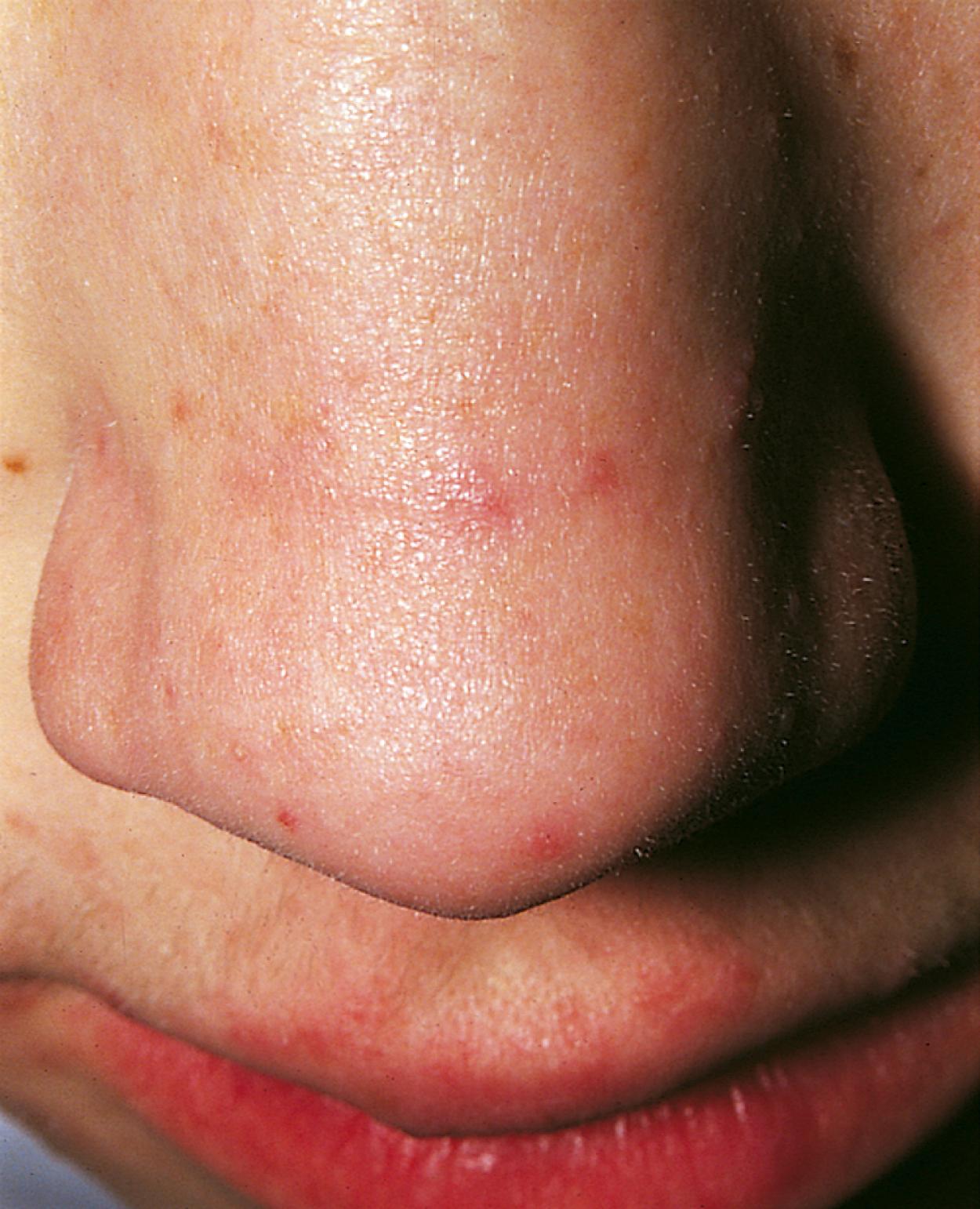 Fig. 4.14, Allergic rhinitis. The nasal crease across the lower third of the nose results from chronic upward rubbing of the nose with the hand (allergic salute).