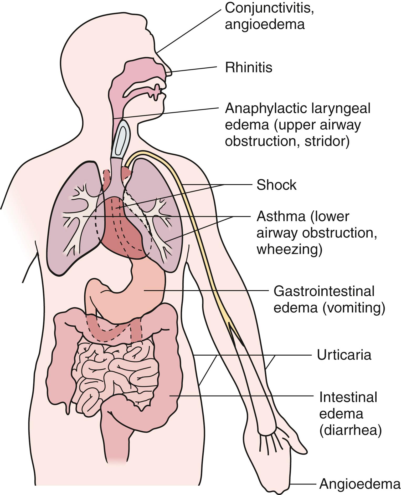 Fig. 4.2, Type I hypersensitivity reactions. Note the characteristic physical findings of each affected organ system.