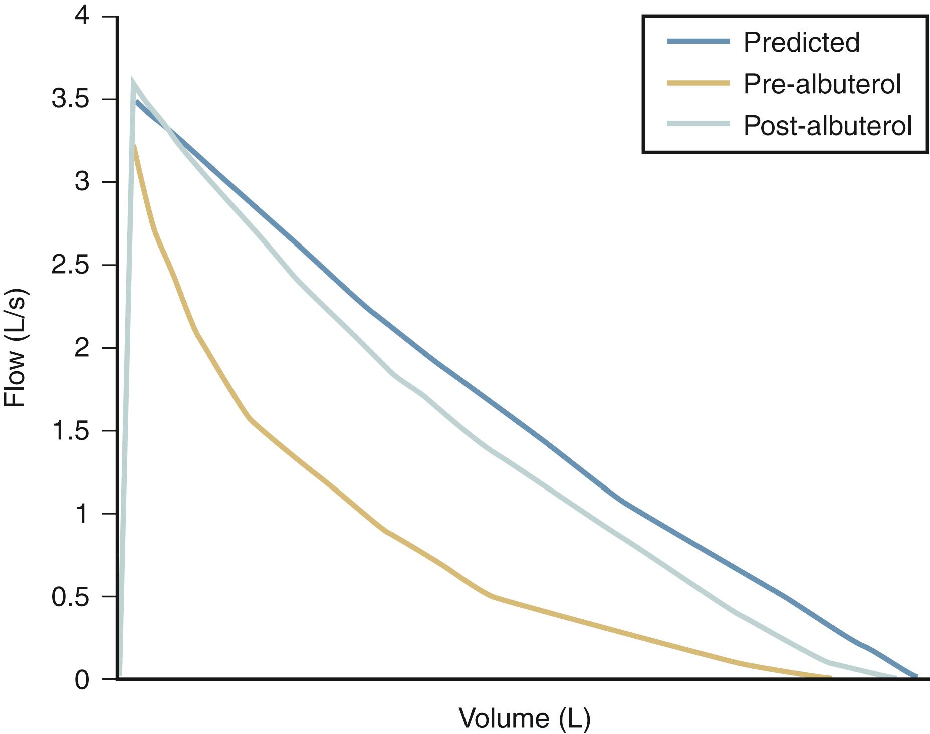 Fig. 4.21, Asthma. Flow/volume loop showing predicted values, initial values, and substantial reversibility after albuterol administration. Note the downward scooping of curves, which is typical in patients with asthma with ongoing obstruction.